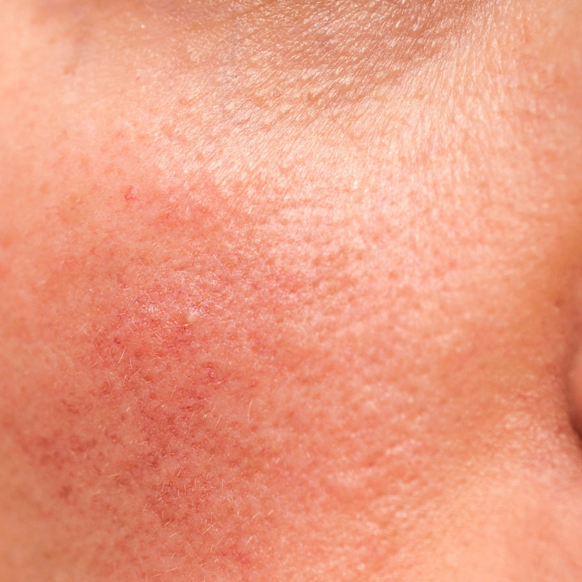 Rundt Om Rosacea: En hurtig oversigt over de oftest stillede spørgsmål - NIMO SKIN