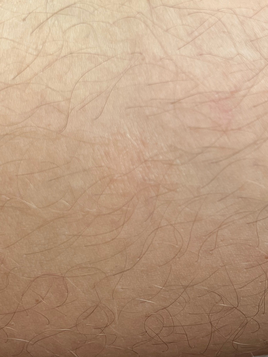 Nummulat eksem næsten væk efter 5 dage med CØLM Redness Relieving Cream